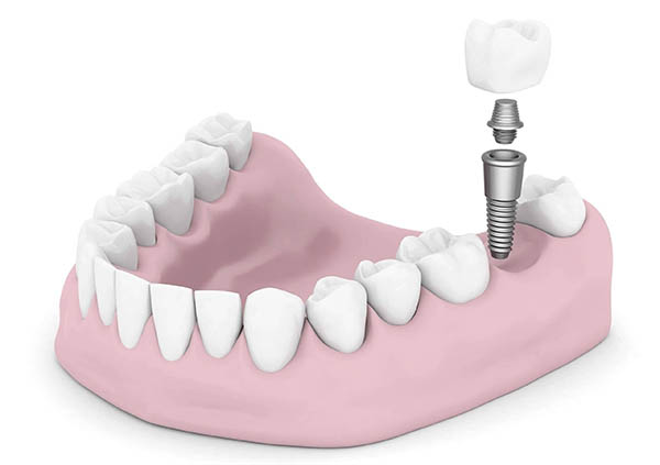 Dental Implants